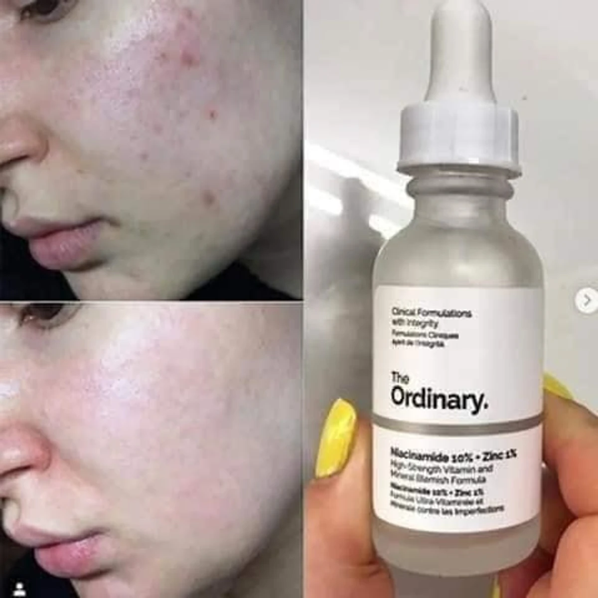 The Ordinary Niacinamide 10% + Zinc 1% 30ml